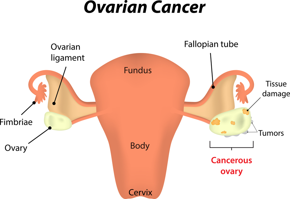 Female reproductive anatomy showing ovarian cancer. Contact the Maryland ovarian cancer lawyer. 