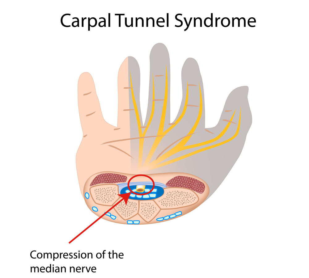 Compression of the median nerve causing carpal tunnel syndrome. Carpal Tunnel Release. Maryland Hand Surgery Lawyer.
