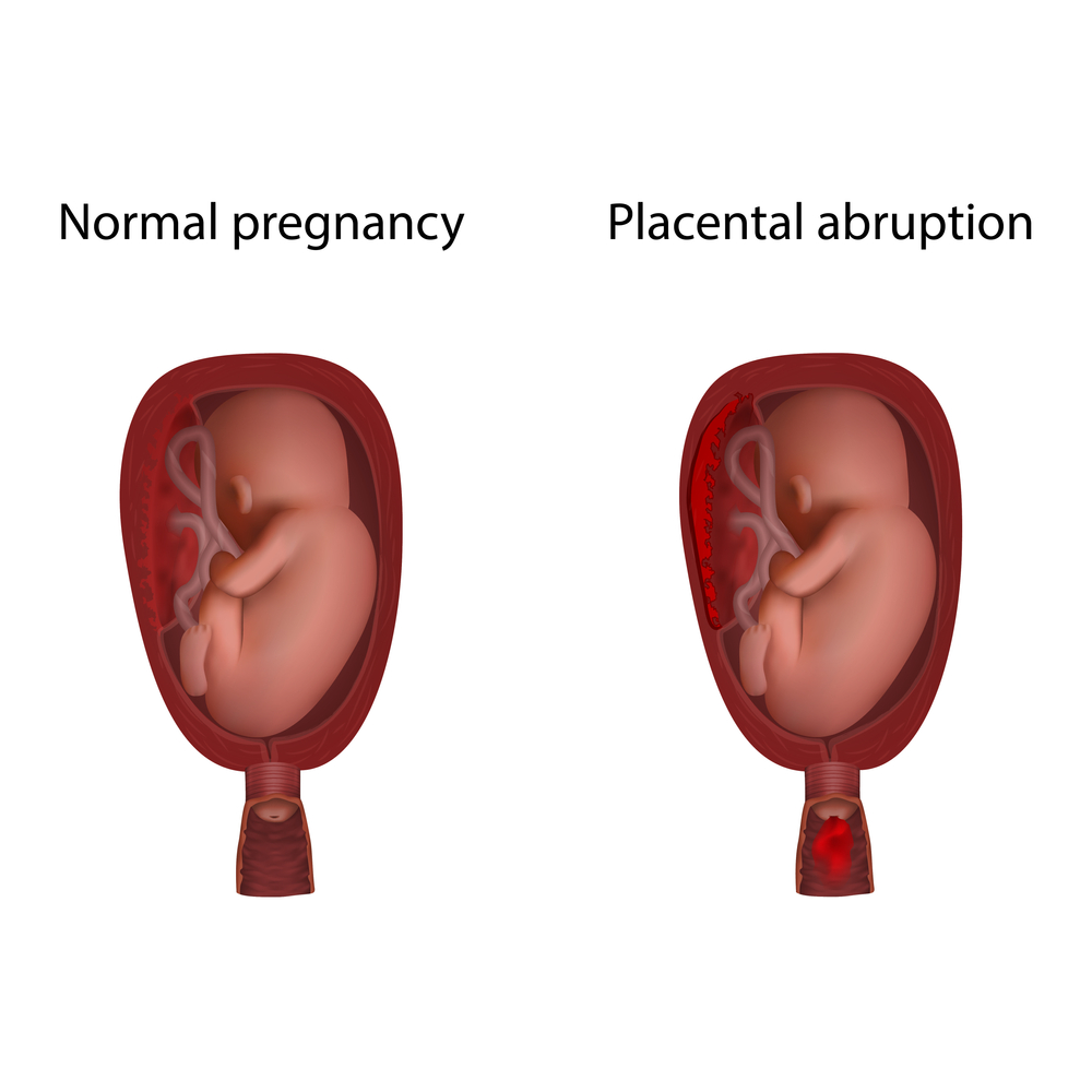 Placental abruption lawyer