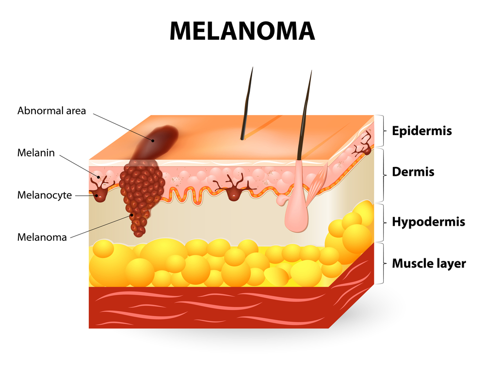 Layers of skin with skin cancer. Skin cancer lawyer