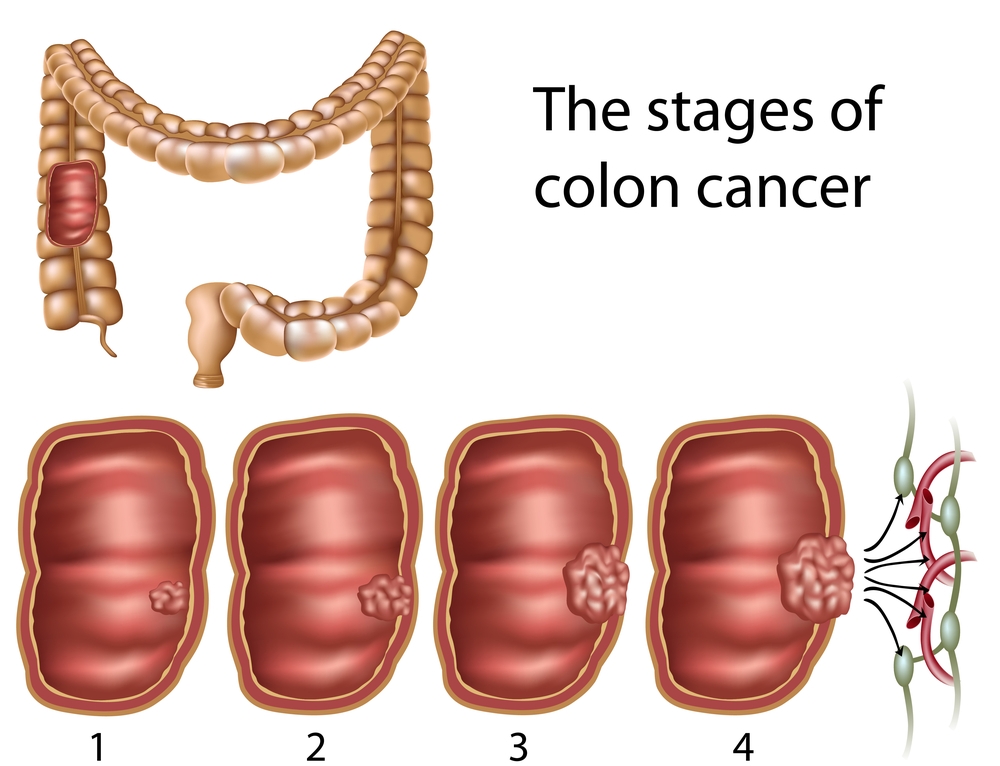 The colon and stages of colon cancer. Maryland colon cancer lawyer.