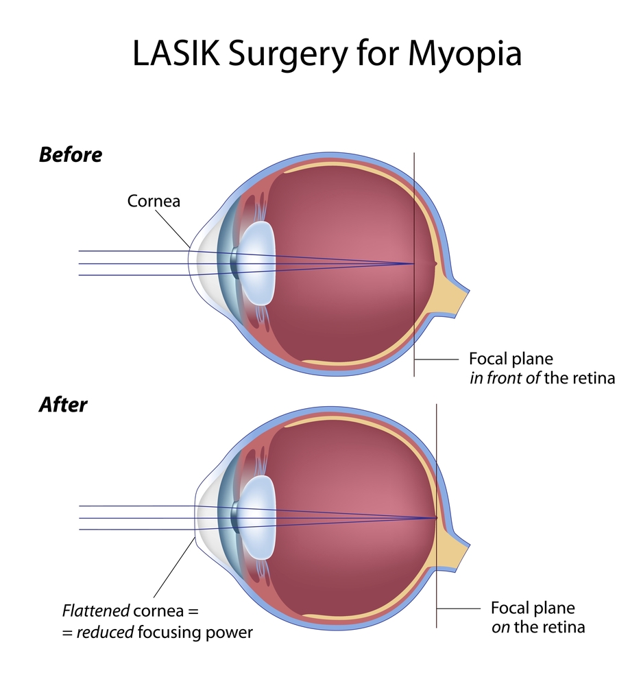 Eye anatomy for Lasik surgery. Maryland eye surgery lawyer