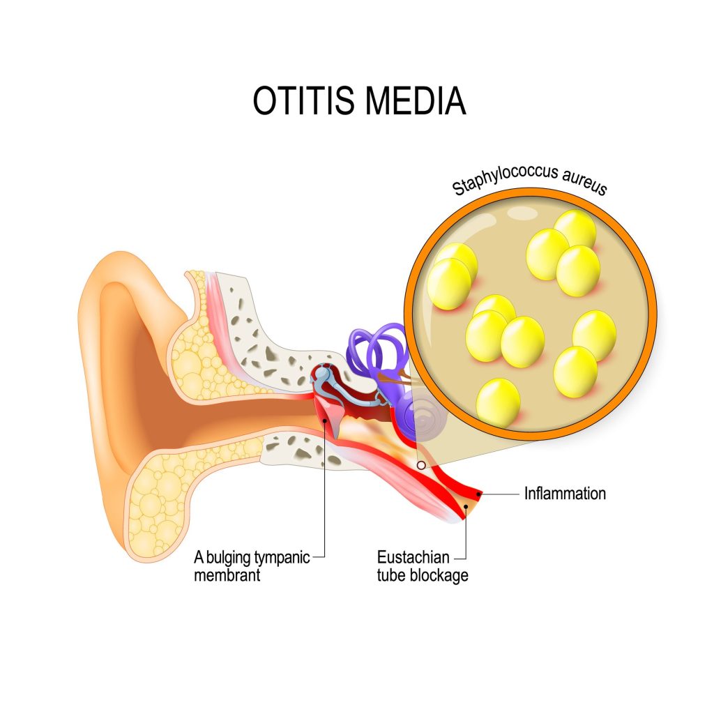 Baltimore Ear Infection Lawyer