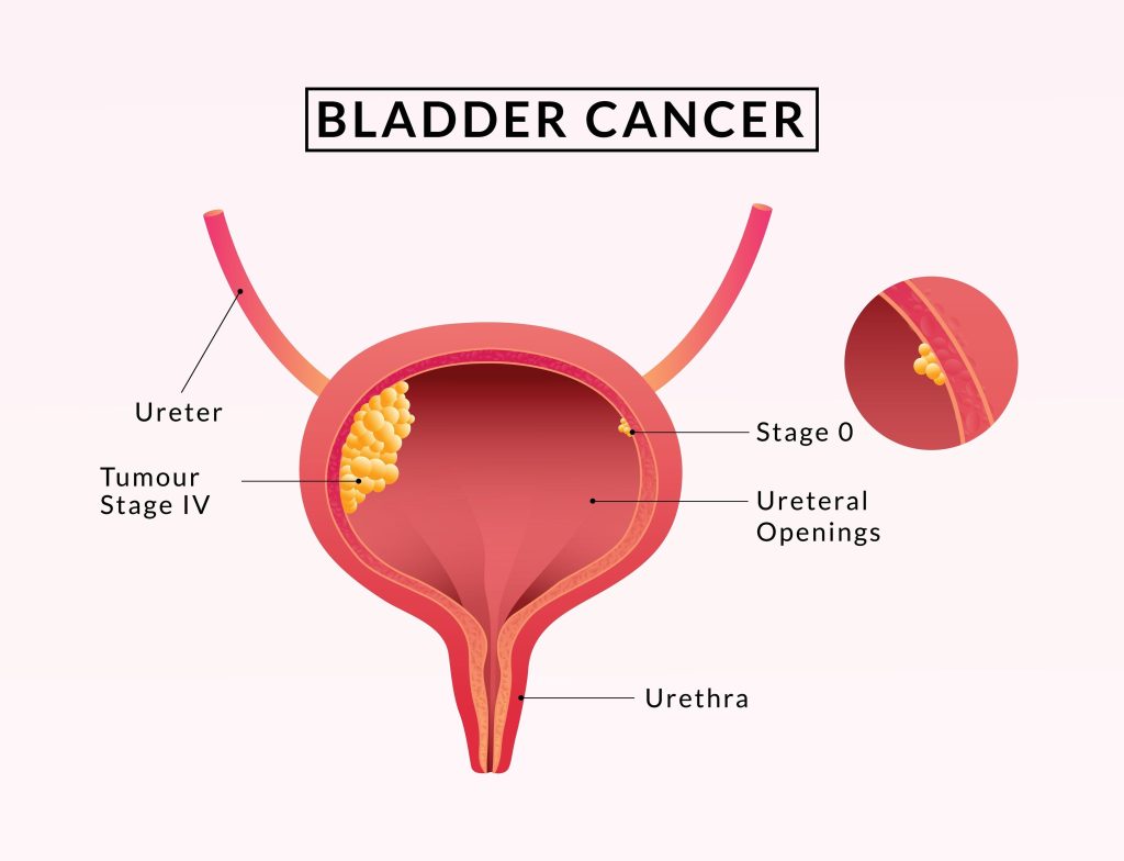 Baltimore Bladder Surgery Lawyer