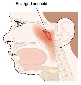 Baltimore Adenoidectomy Lawyer