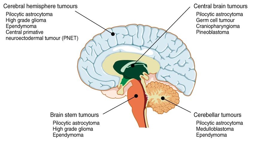 Baltimore Brain Cancer Lawyer
