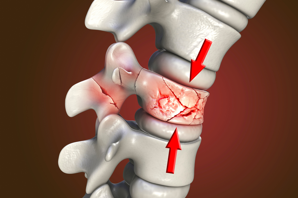 Baltimore Spine Injury Lawyer