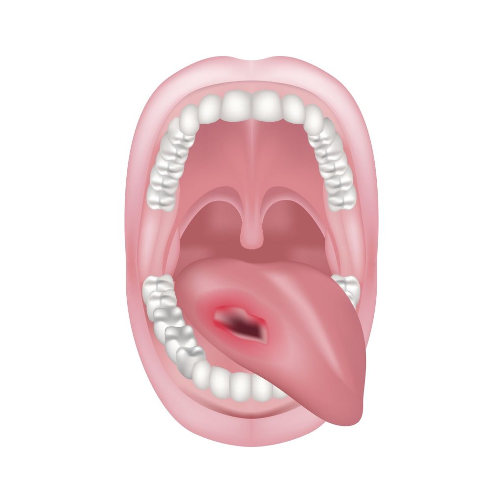 Baltimore Oral Cancer Lawyer