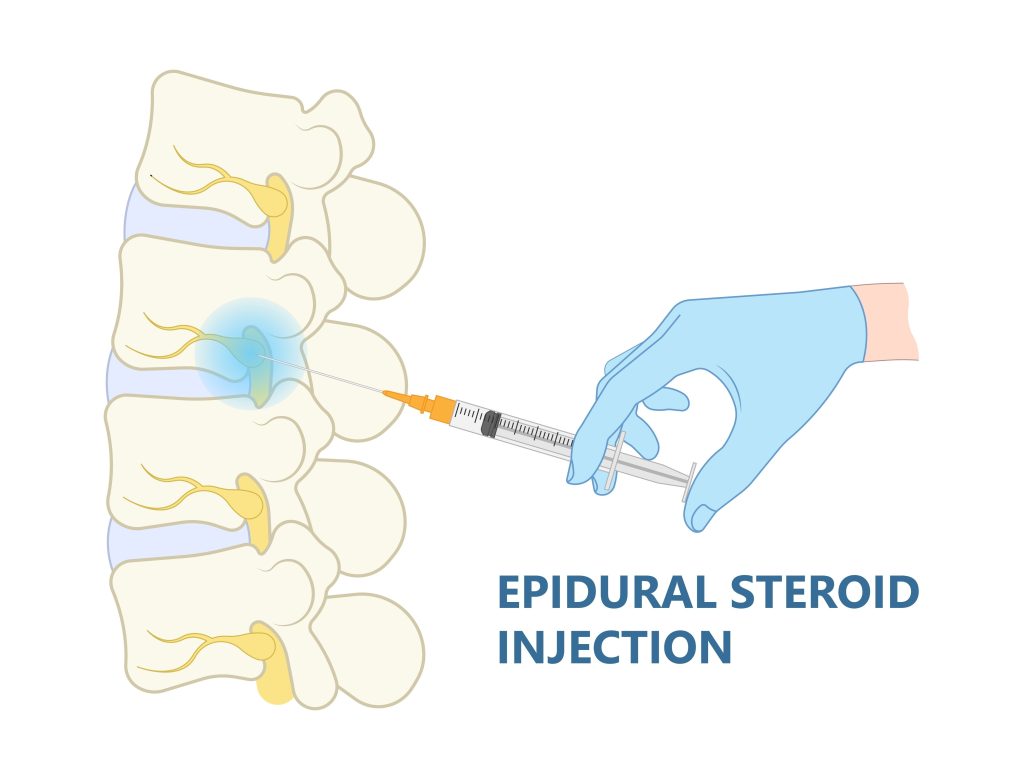 ESI Medical Malpractice