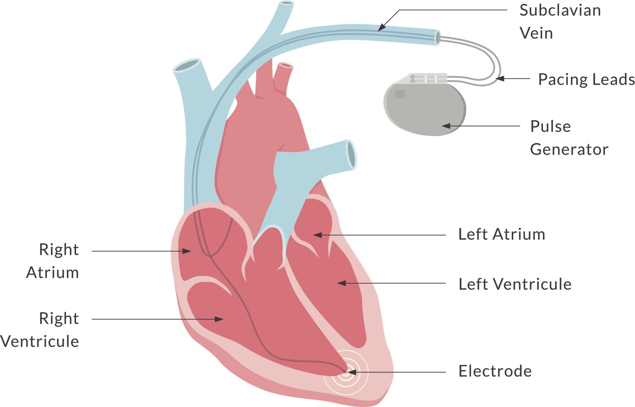 Pacemaker | Baltimore Medical Malpractice Lawyer Kopec Law Firm