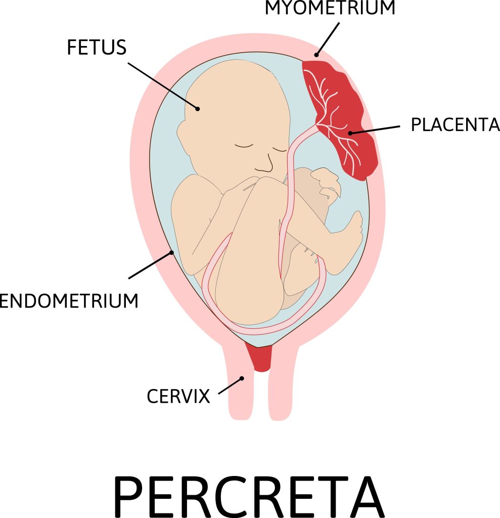 Placenta Percreta Birth Injury