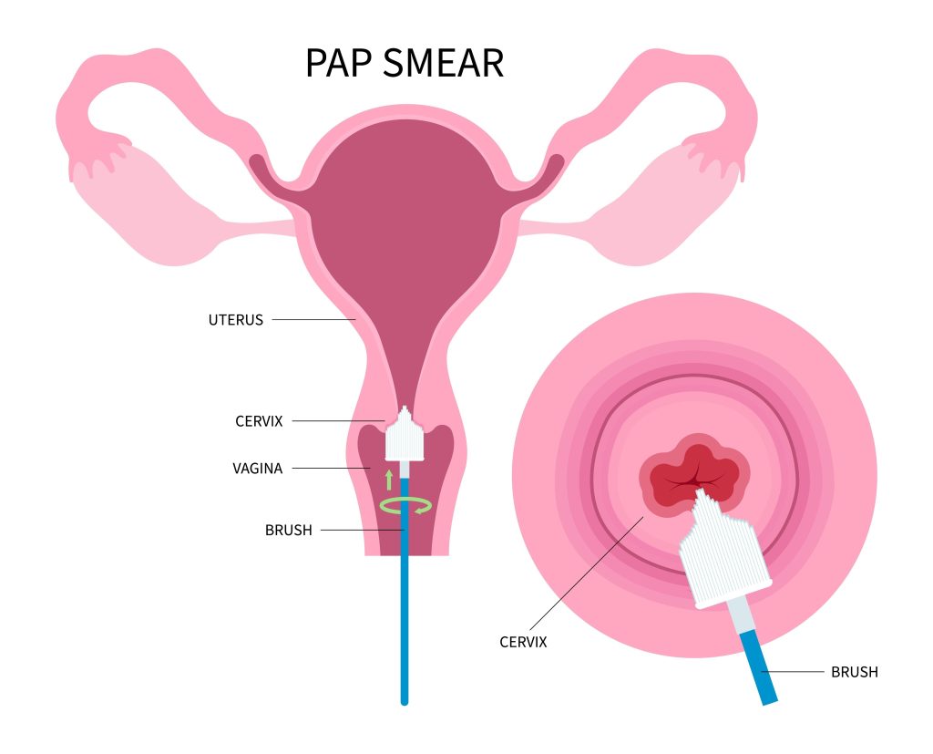Pap Smear Medical Malpractice