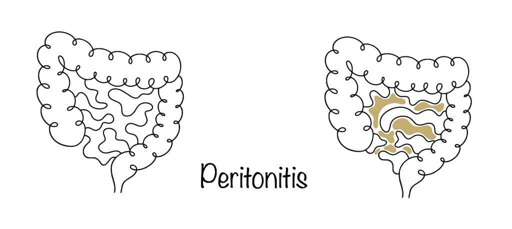 Peritonitis Medical Malpractice