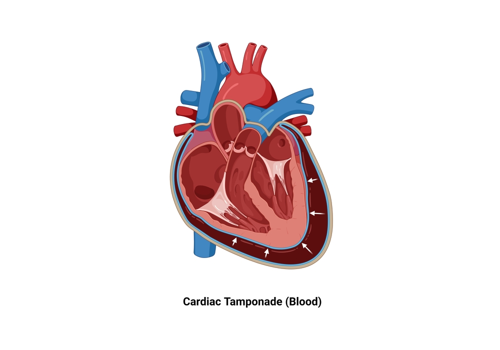 Baltimore Cardiac Tamponade Lawyer