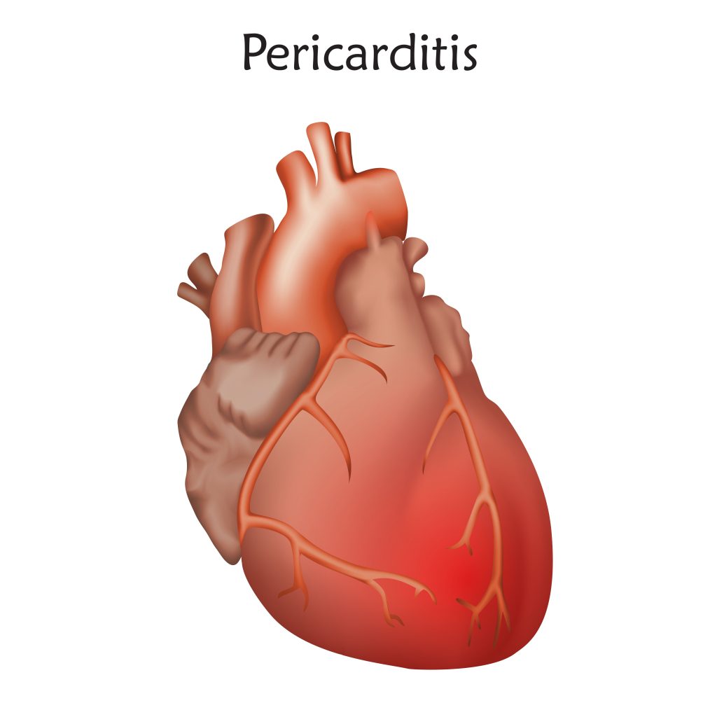 Pericarditis Medical Malpractice