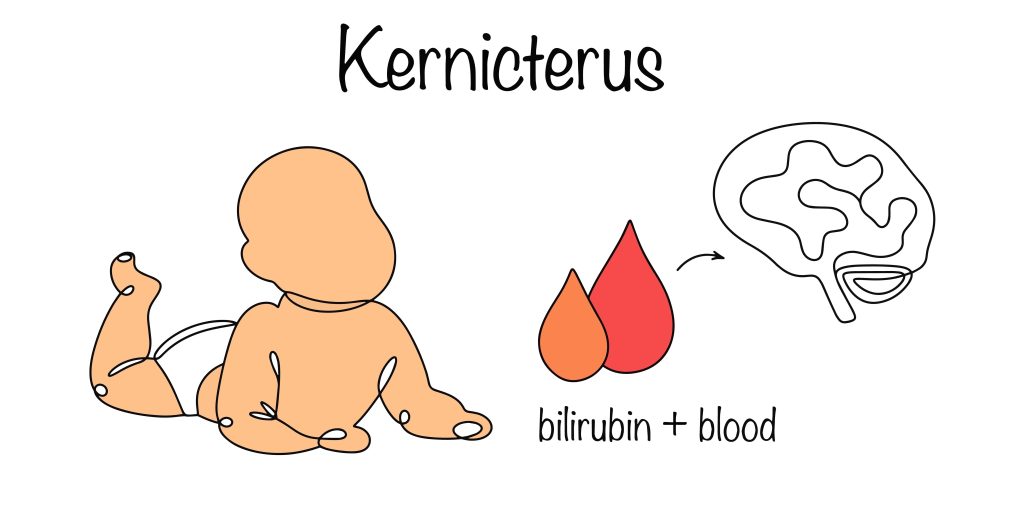 Baltimore Kernicterus Lawyer