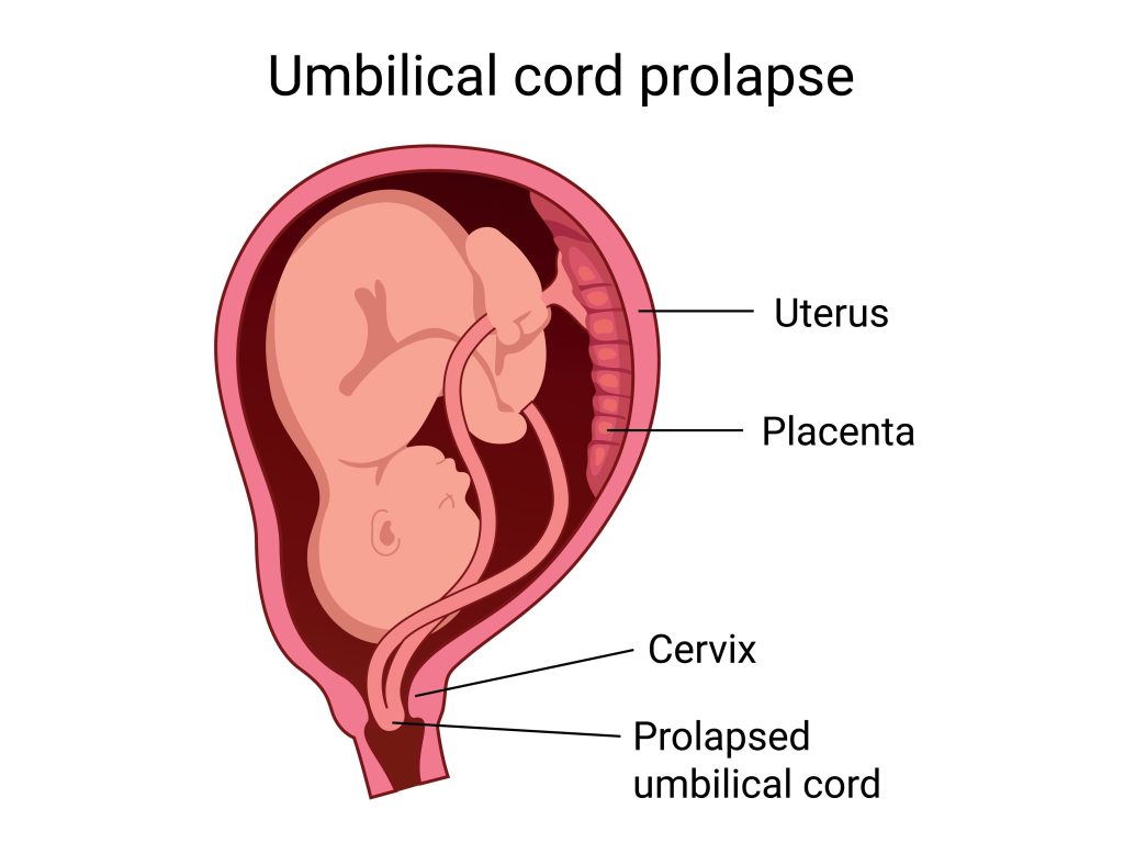Umbilical Cord Prolapse - Medical Malpractice