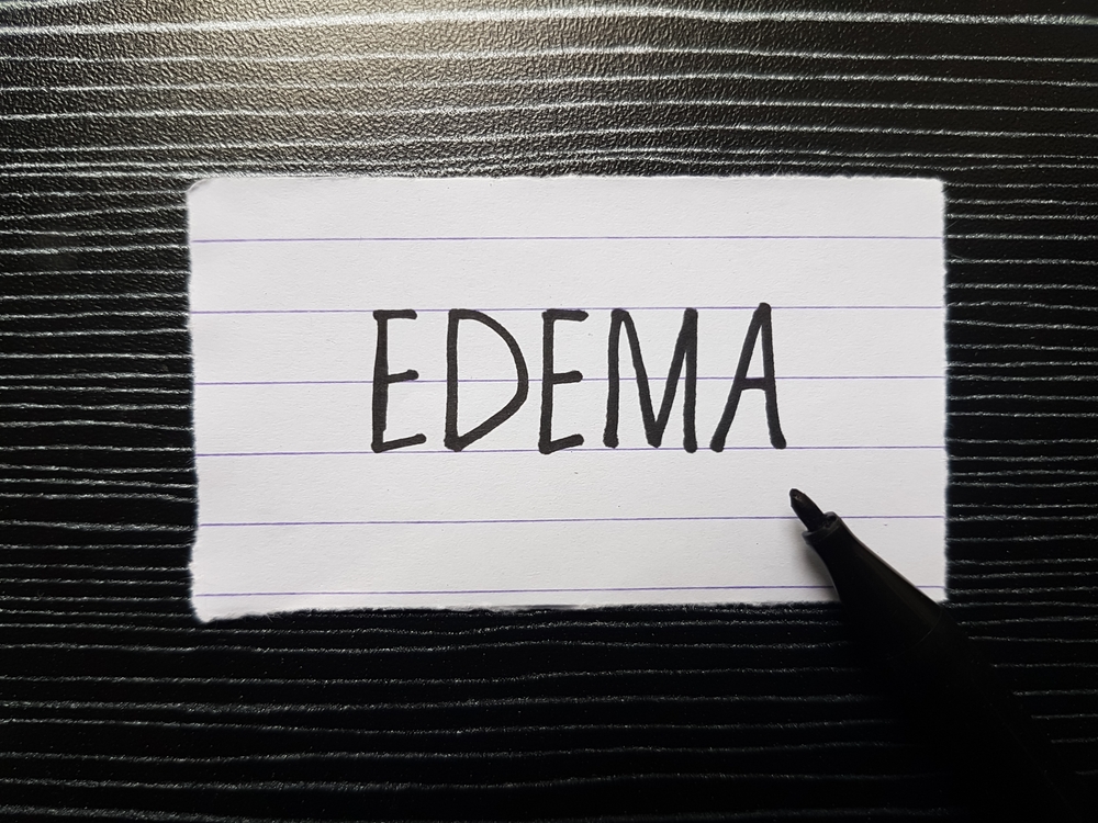 Edema Medical Malpractice